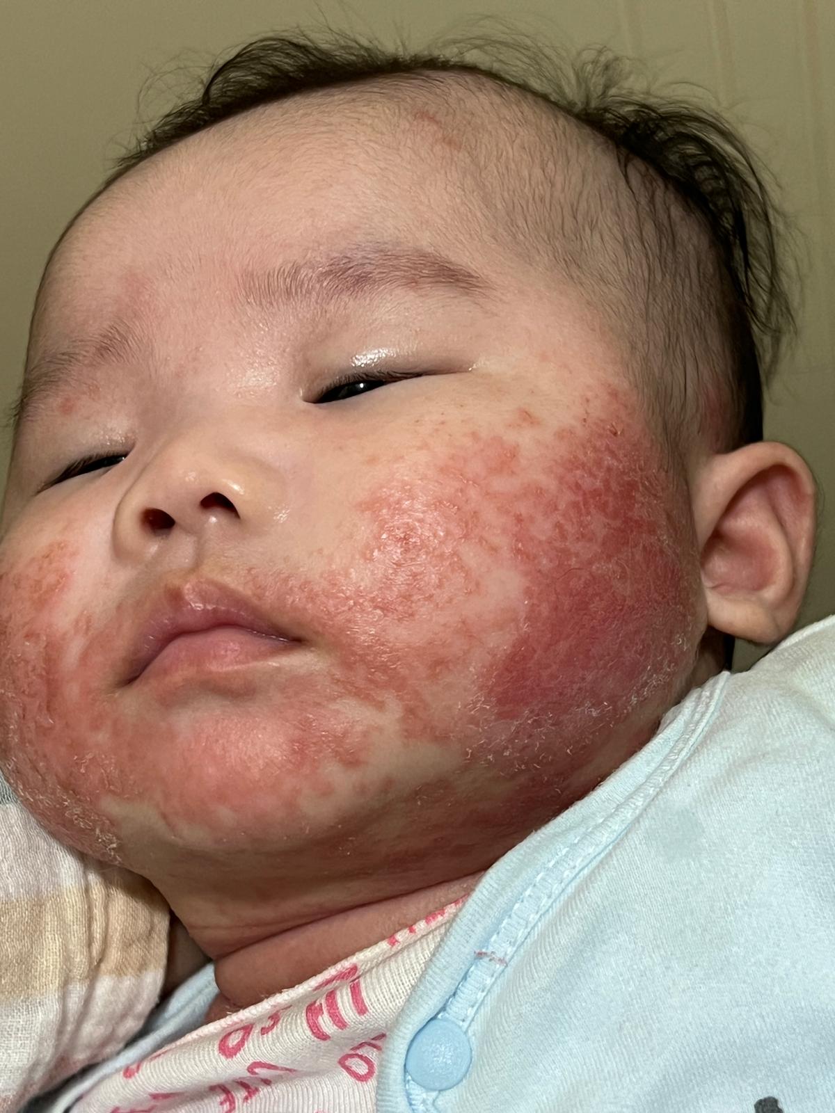 寶寶未轉飲Kabrita佳貝艾特羊奶粉前的濕疹問題十分嚴重。