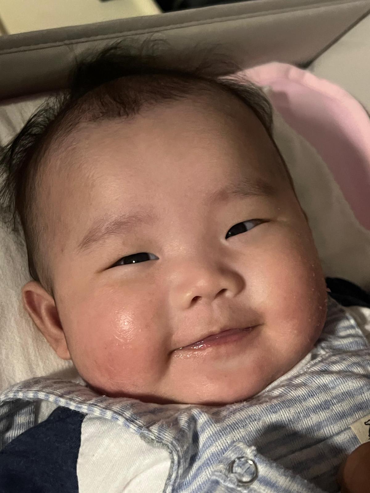 轉飲Kabrita佳貝艾特羊奶粉後第4天濕疹狀況已明顯好轉。