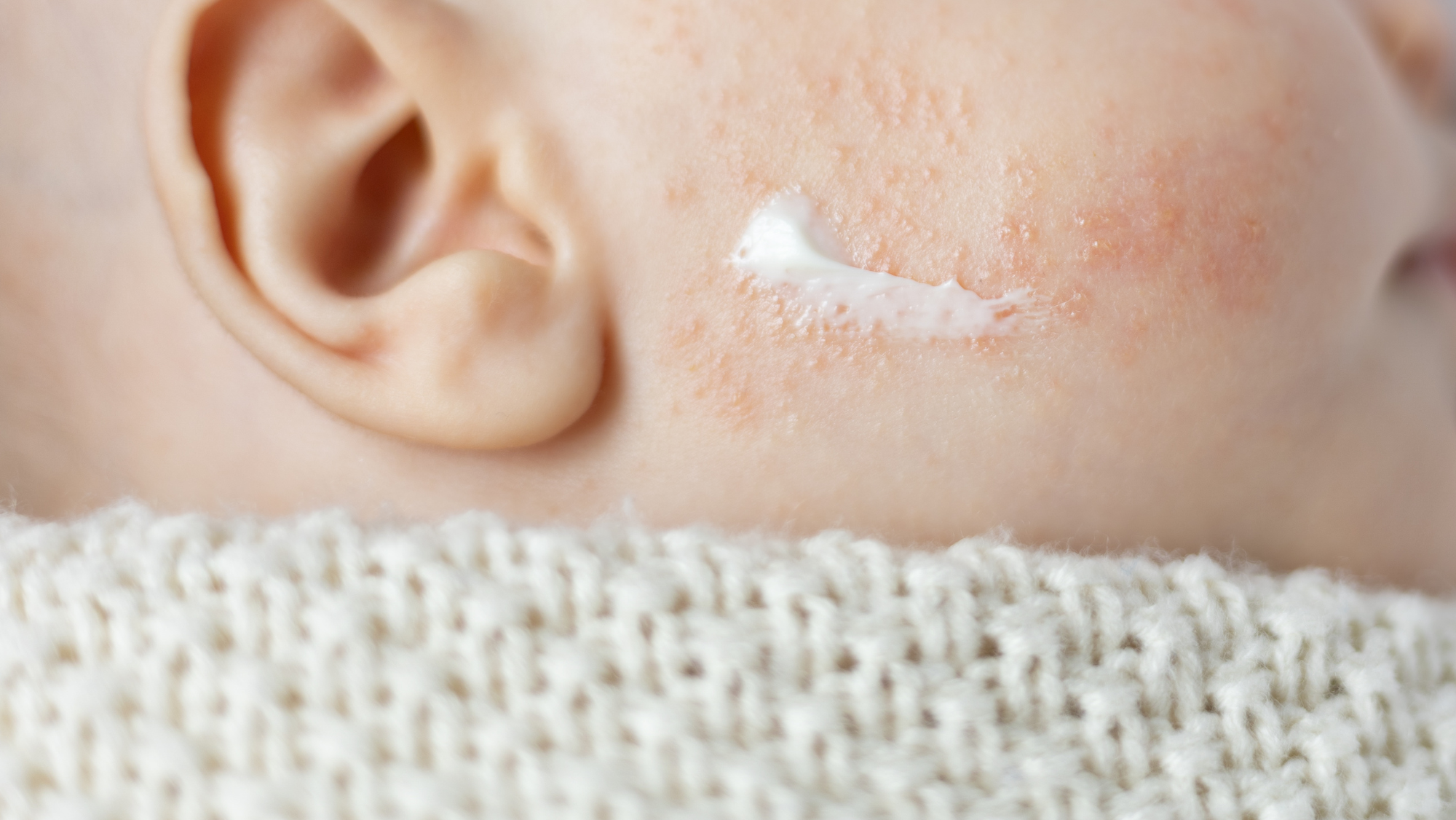 很多家長在面對孩子濕疹時都會擔心「究竟用不用類固醇」,既怕濕疹惡化又怕出現類固醇上癮的問題。Kabrita和你一起了解濕疹,幫助你解決寶寶濕疹困擾。