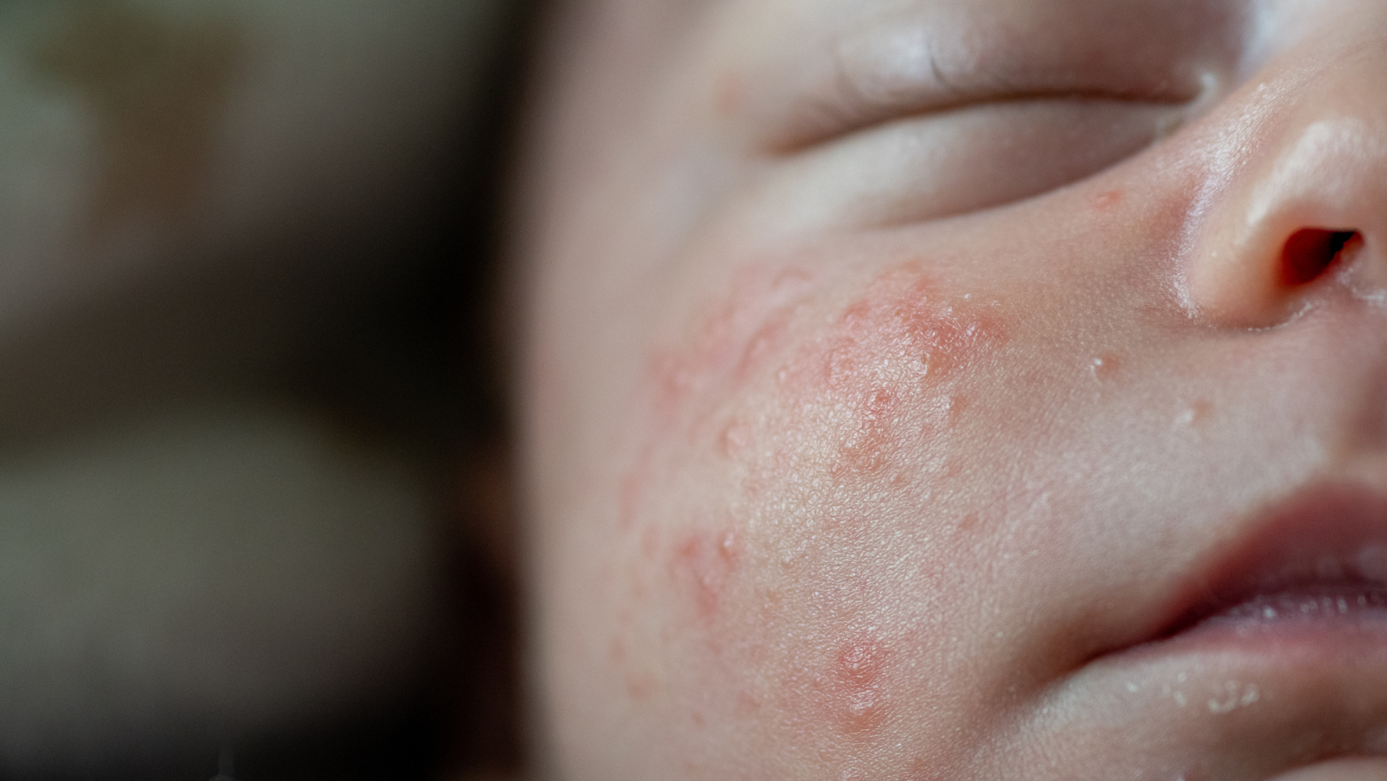 因為嬰幼兒的皮膚屏障尚未發育完成,所以更容易出現濕疹問題。天氣、濕度、過敏原、腸道敏感、情緒等都是導致寶寶濕疹出現的常見原因。