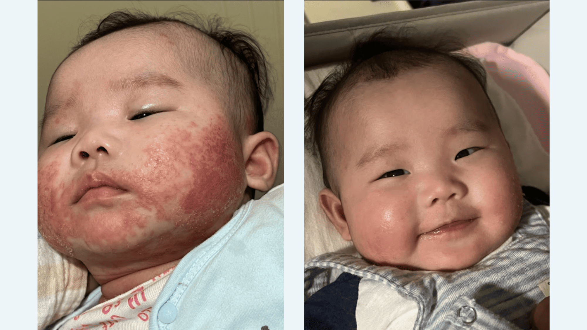 98%媽媽推薦Kabirta佳貝艾特羊奶粉，真實用家分享濕疹寶寶轉飲Kabrita羊奶粉後4天已經有明顯好轉。