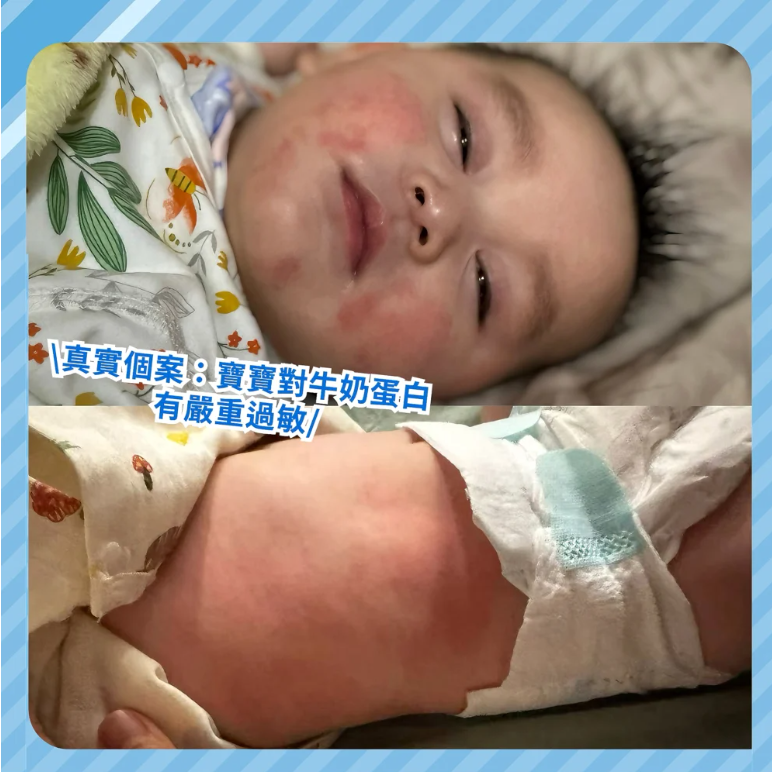 仔仔玥辰在6個月大停止母乳餵哺並轉喝牛奶後，濕疹問題突然爆發。經醫生診斷，才發現仔仔對牛奶蛋白有嚴重過敏。